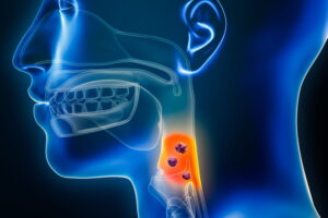 Lire la suite à propos de l’article Cancer de la Gorge : Symptômes, Causes et Espoir de Vie Face à la Maladie